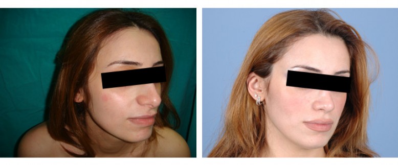 Rhinoplasty Before and After