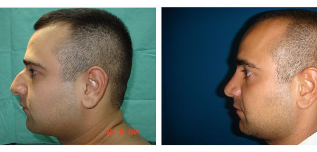 Rhinoplasty Before and After