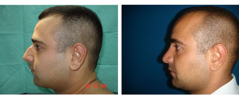 Rhinoplasty Before and After