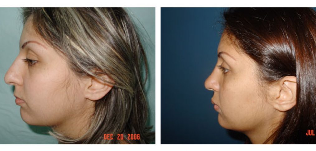Rhinoplasty Before and After