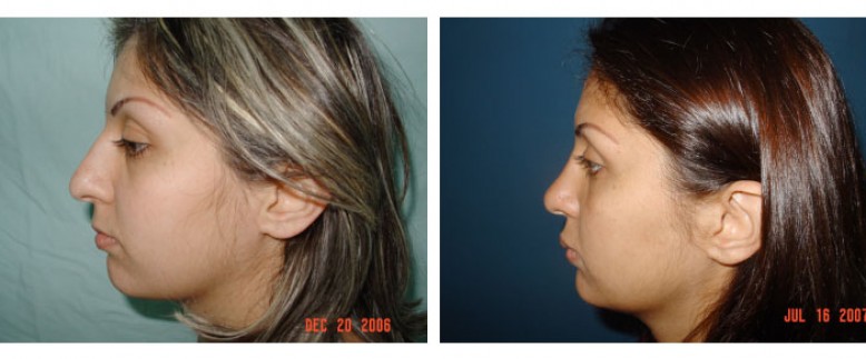 Rhinoplasty Before and After