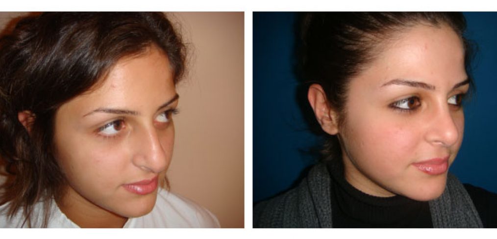 Rhinoplasty Before and After