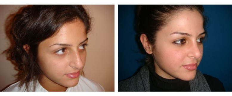 Rhinoplasty Before and After