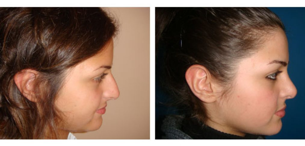Rhinoplasty Before and After