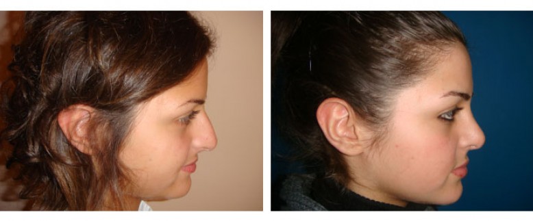 Rhinoplasty Before and After