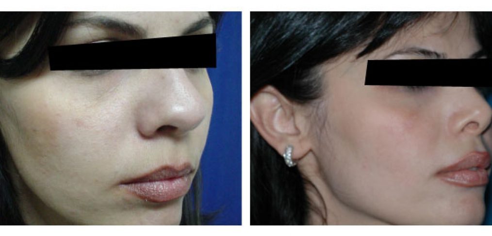 Rhinoplasty Before and After