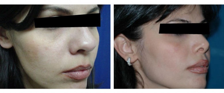 Rhinoplasty Before and After