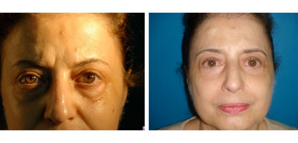 Blepharoplasty Before and After