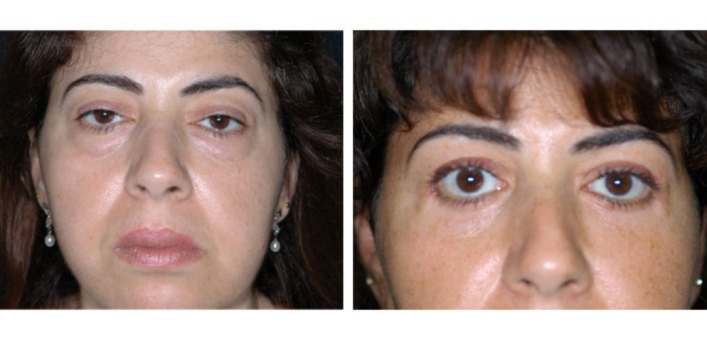 Blepharoplasty Before and After