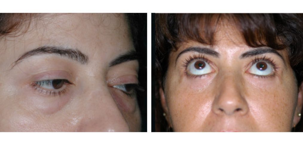 Blepharoplasty Before and After