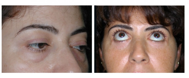 Blepharoplasty Before and After