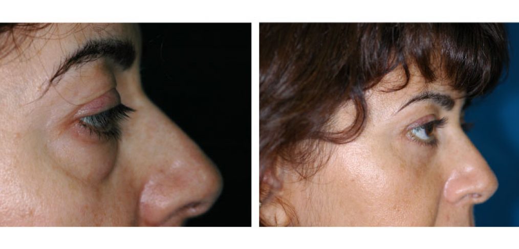 Blepharoplasty Before and After