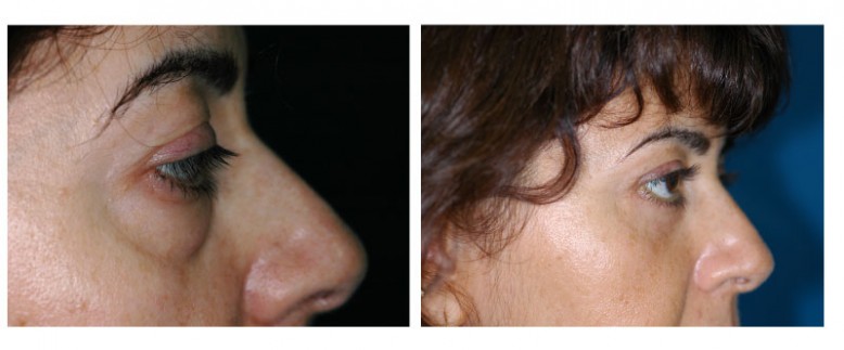 Blepharoplasty Before and After