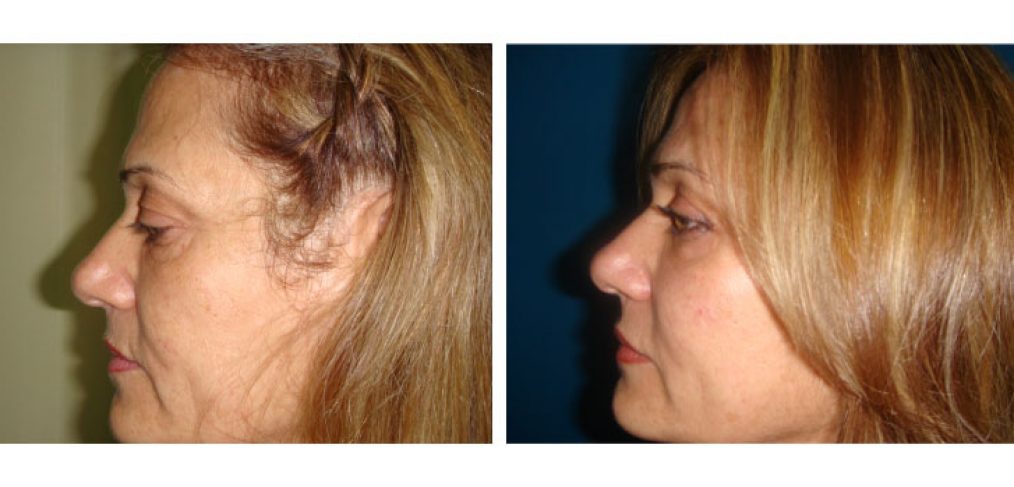 Blepharoplasty Before and After