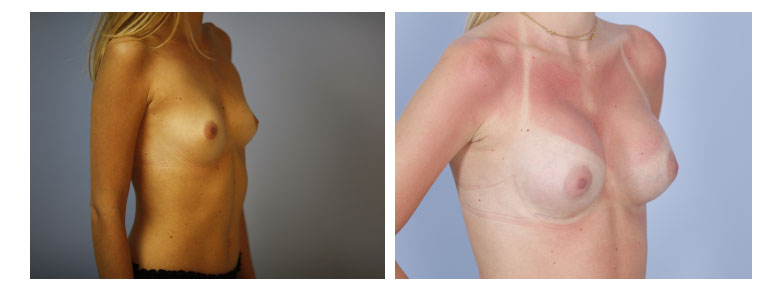 Inframammary Access Submuscular Implants