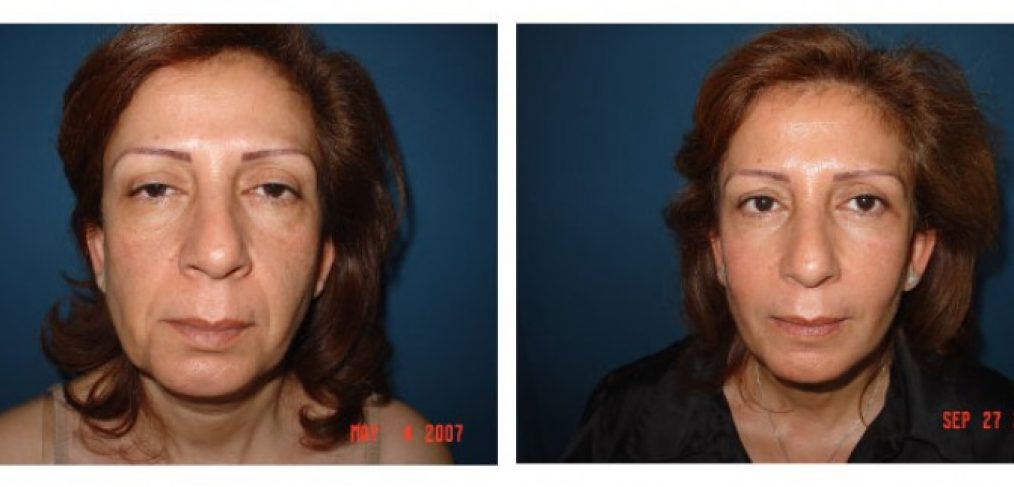 Facelift Before and After