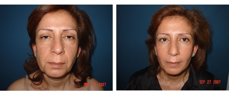 Facelift Before and After