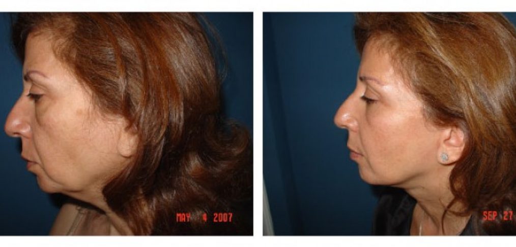 Facelift Before and After