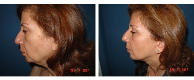 Facelift Before and After