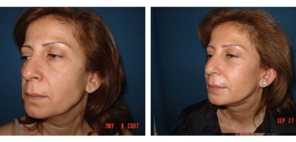 Facelift Before and After