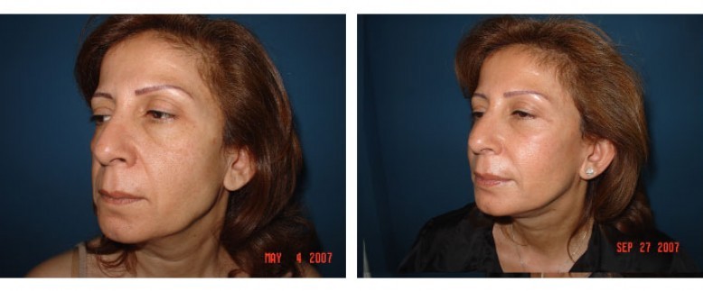 Facelift Before and After