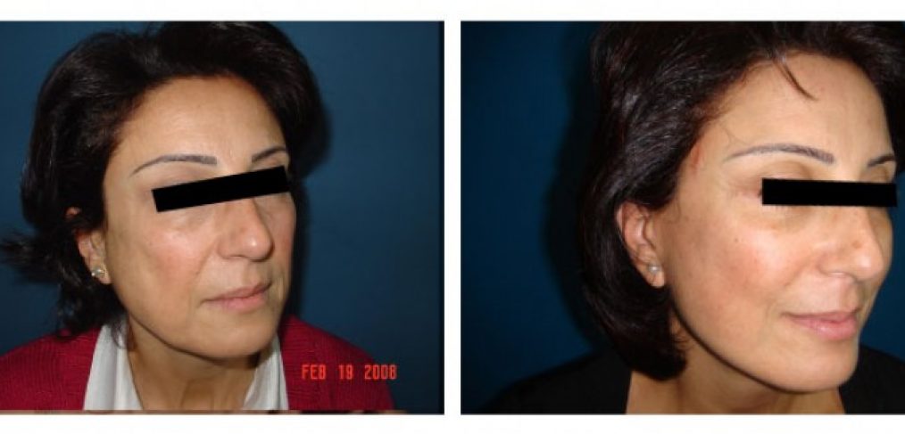 Facelift Before and After