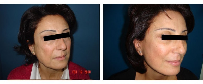 Facelift Before and After