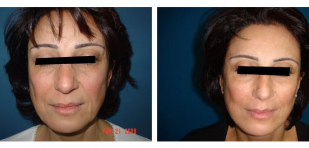 Facelift Before and After