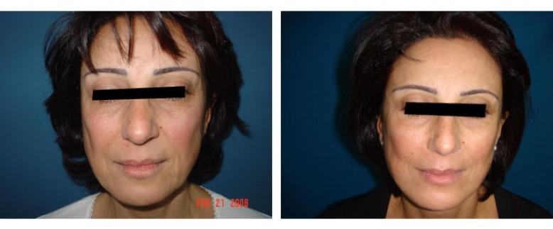 Facelift Before and After