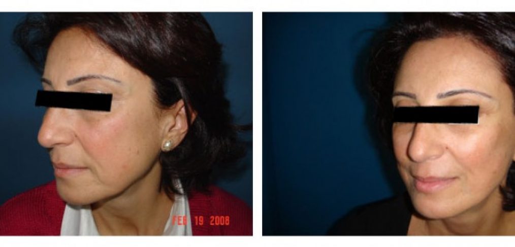 Facelift Before and After