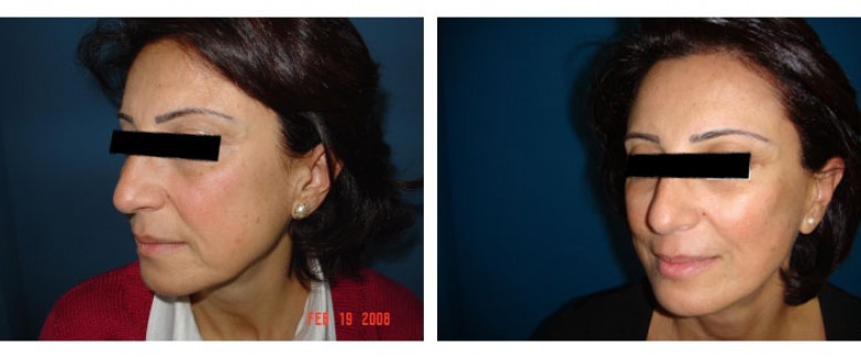 Facelift Before and After