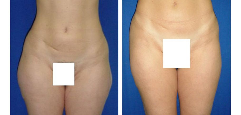 Liposuction Before and After