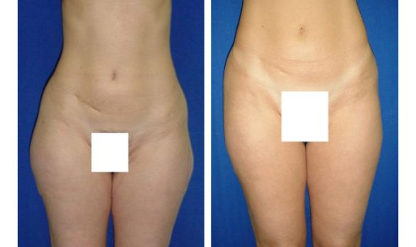 Liposuction Before and After