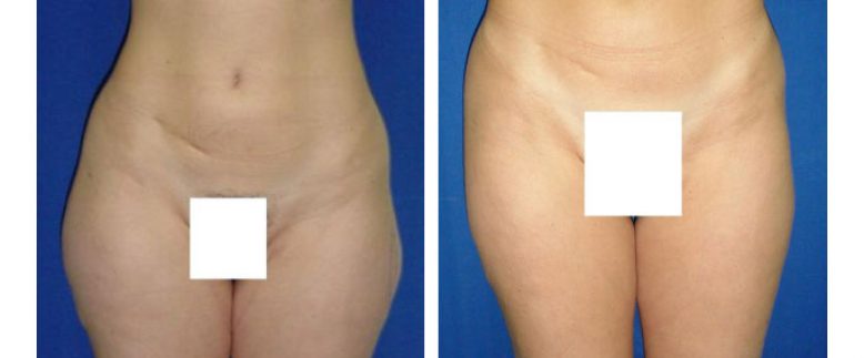 Liposuction Before and After