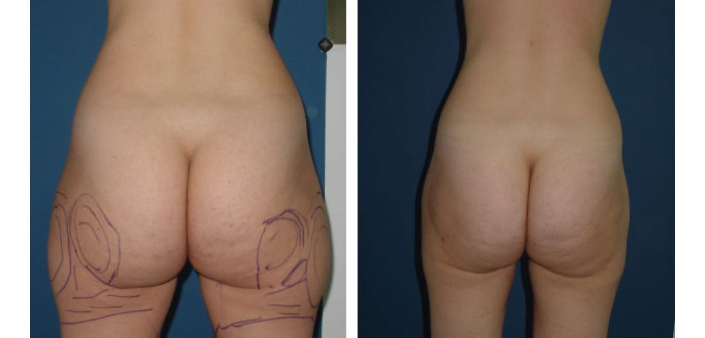 Liposuction Before and After