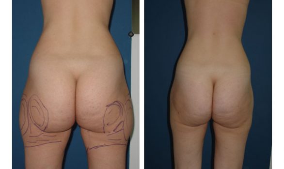 Liposuction Before and After