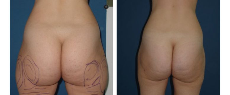 Liposuction Before and After