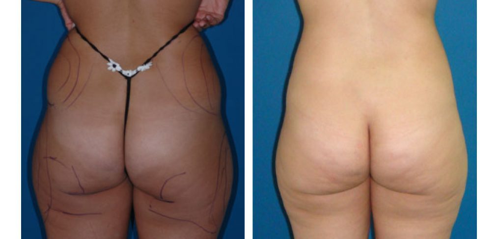 Liposuction Before and After