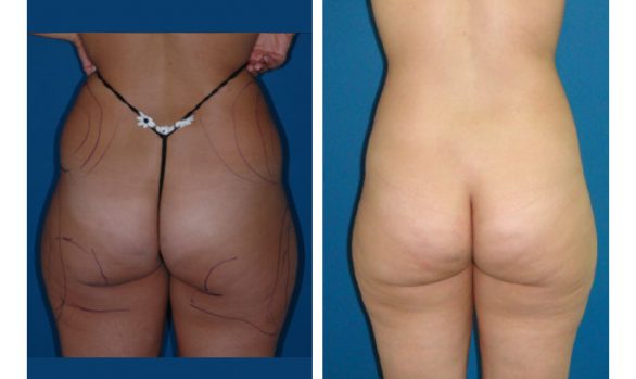 Liposuction Before and After