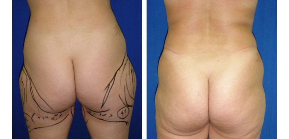 Liposuction Before and After