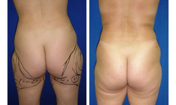 Liposuction Before and After