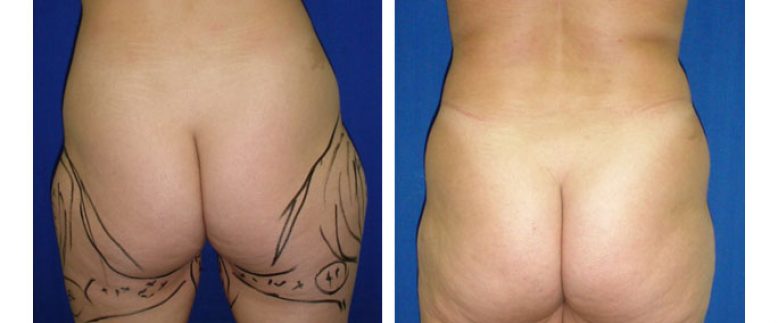 Liposuction Before and After